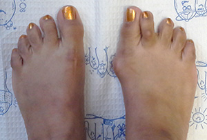 Bunions