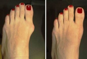 Bunions