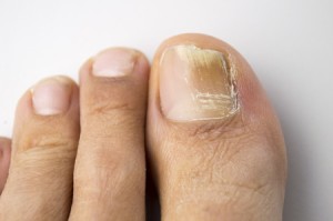 Fungal Toenail