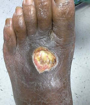Infected Wounds