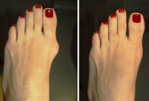 Bunion Surgery in Dallas