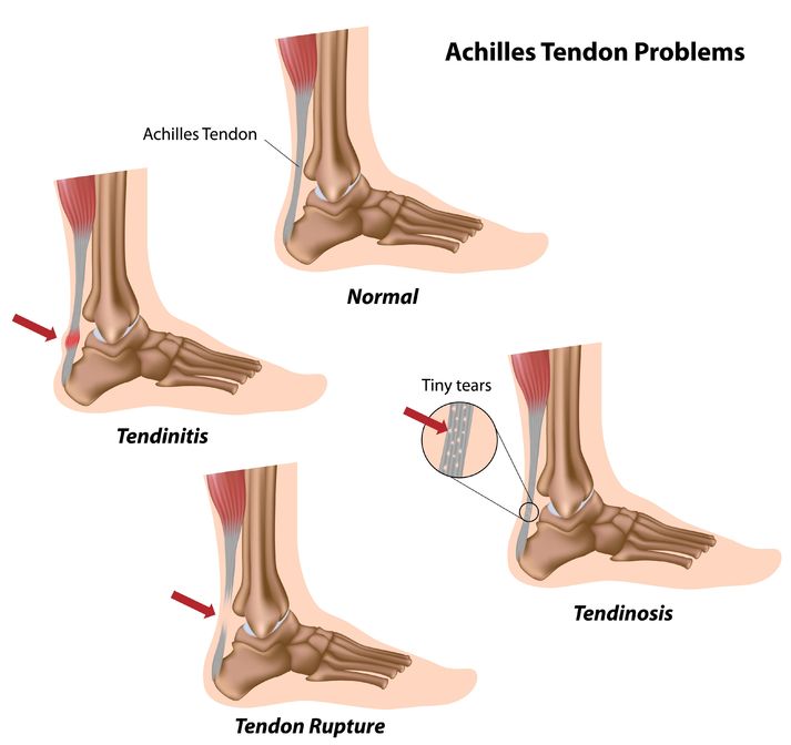 tendonitis heel pain