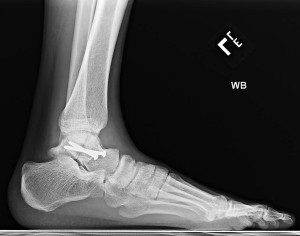 ankle fracture surgery