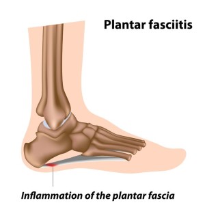 plantar fasciitis cure time