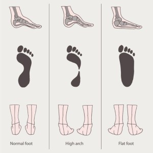 foot arches, flat feet dallas