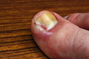 ingrown toenails