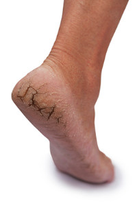 Dead Skin Under Feet: Causes, Symptoms, And Treatment