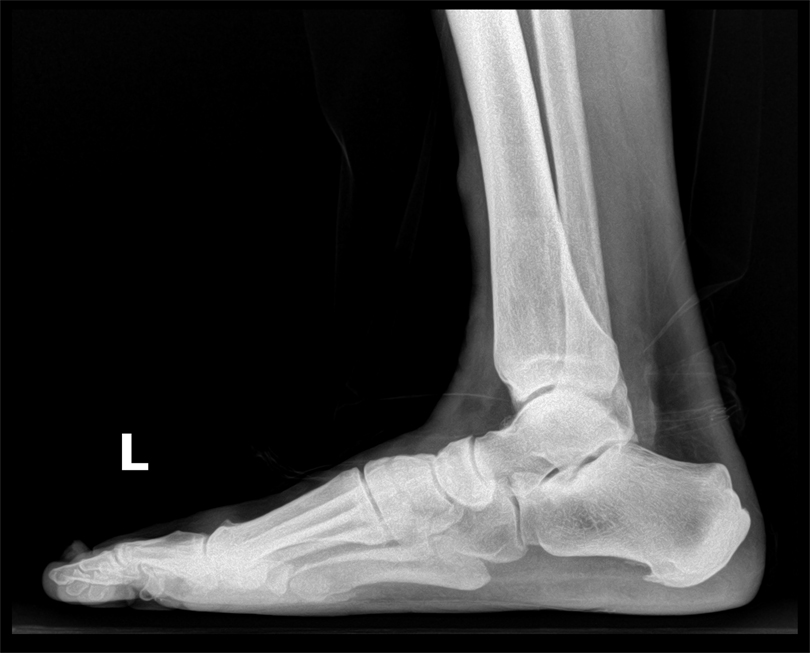 Bilateral calcaneal clearance spur treatment