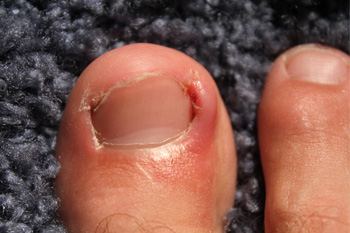 Stages of an Ingrown Toenail - Advanced Foot & Ankle Care Specialists