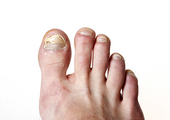 Signs You Have Developed Nail Fungus - Advanced Foot & Ankle Care  Specialists