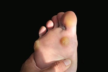 Tips for Preventing Corns and Calluses