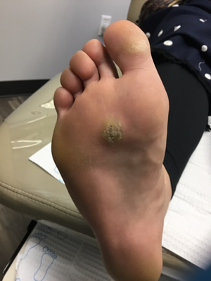 wart on foot infected)