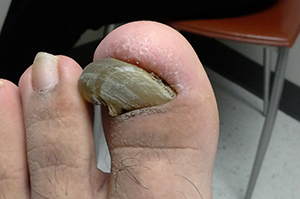 severe toenail fungus