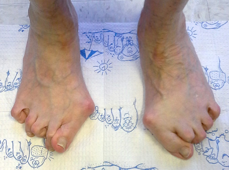 severe bunions