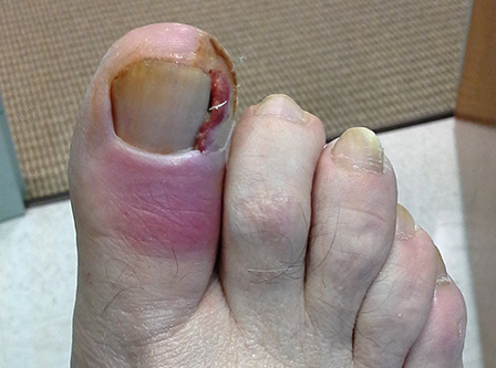 Ingrown Toenails