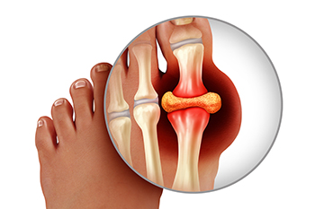 Plantar fasciitis vs. gout: Similarities and differences