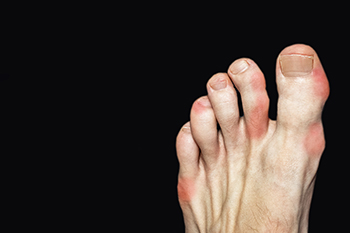 arthritis in little toe
