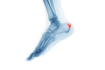 The Definition of a Heel Spur - Advanced Foot & Ankle Care Specialists