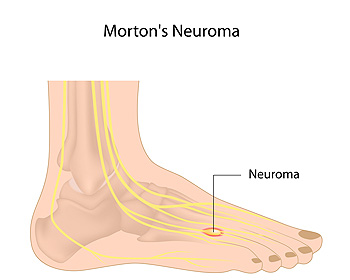 Morton's Neuroma and Pinched Nerves 